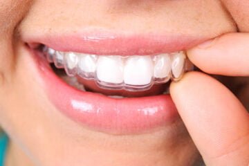 Aparatele dentare Spark: ce sunt, cum funcționează și care sunt beneficiile